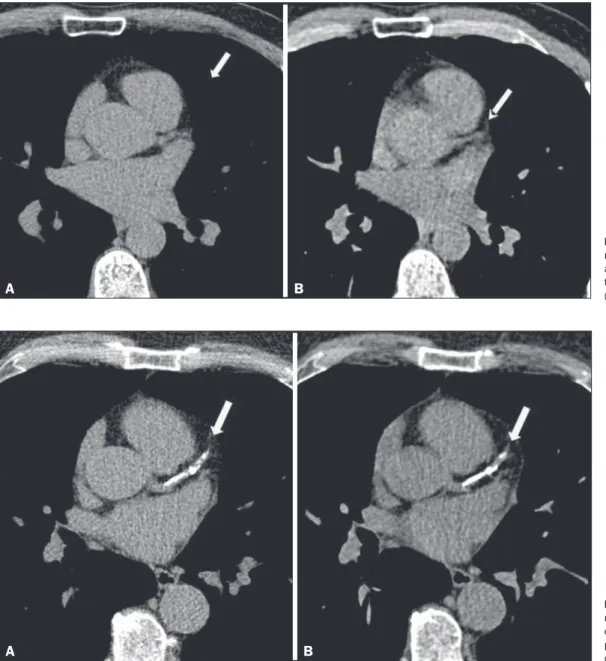 Figure 1.  Triggered  CT  (A) and  nontriggered CT ( B ), showing the  absence  of  calcification  in  the  trunk of the left coronary artery  (arrow).