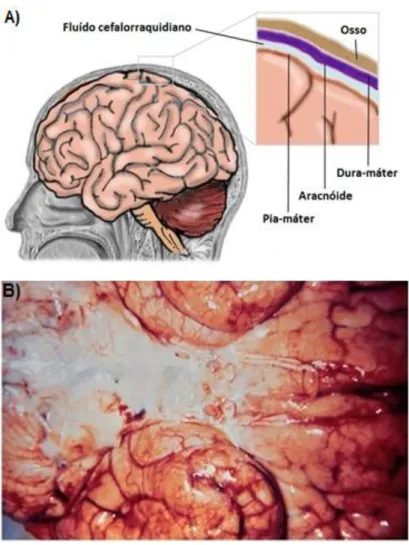 Figura 21: (A) Esquema ilustrativo das meninges e (B) Meninges infectadas com Haemophilus  influenzae e 