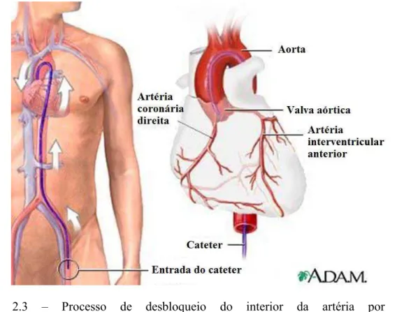 Figura  2.3  –  Processo  de  desbloqueio  do  interior  da  artéria  por  ACTP  (http://se3.adam.com/content.aspx?productId=125&amp;pid=71&amp;gid=100160)