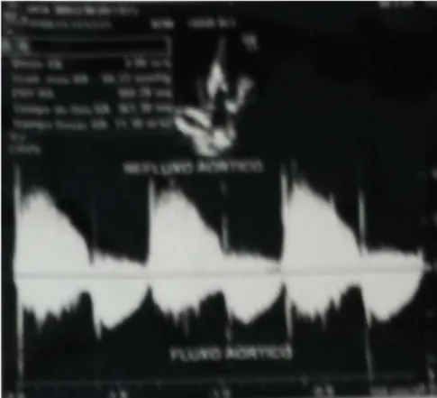 Figura 5 – Imagem de ecocardiograma revelando regurgitação aórtica importante 