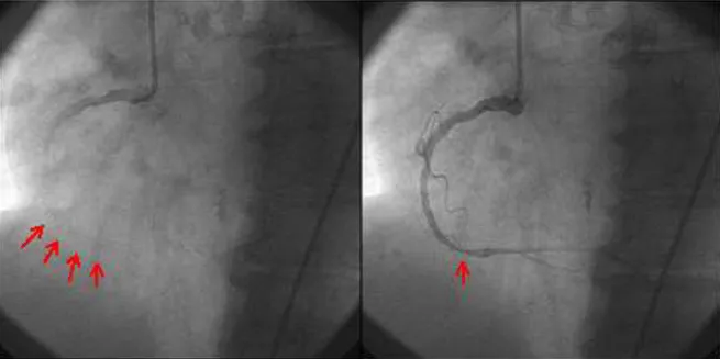 Figura 6 – Coronariografia da artéria coronária direita. À esquerda, antes da injeção total do contraste, vê-se  no terço médio um stent (assinalado pelas setas)