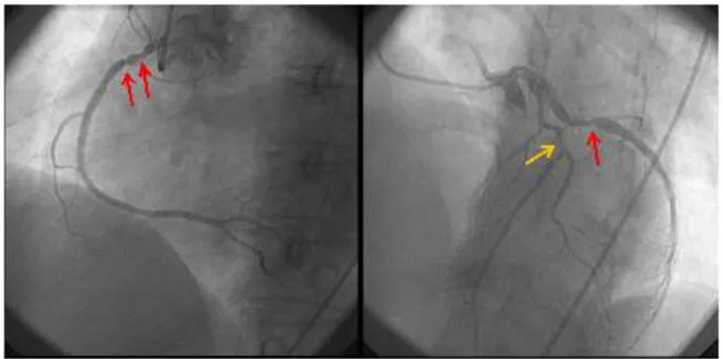 Figura 6 – Coronariografia. À esquerda, a artéria coronária direita tem uma estenose no terço proximal
