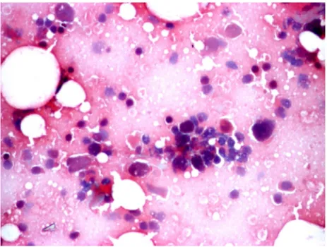 Figure 1-  Myoepithelial carcinoma, cytology. Smears have rich cellularity and are dominated by polygonal pleomorphic tumor cells with  abundant delicate cytoplasm