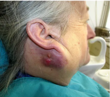 Figure 3-  Oncocytic carcinoma, clinical aspect. A right-sided subcutaneous inferior retro-auricular mass is observed, with a somewhat  bosselated surface