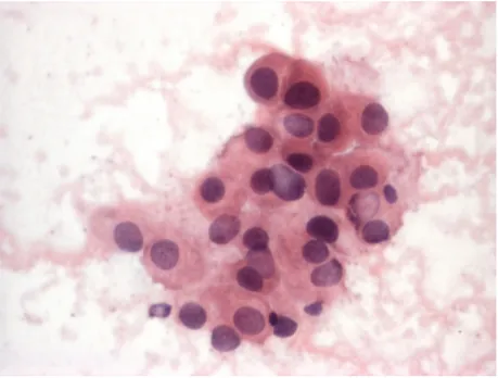 Figure 4-  Oncocytic carcinoma, cytology. A group of oncocytic cell is observed. The cells show moderate nuclear atypia (hyperchromasia,  slight  nuclear  membrane  irregularities,  anisonucleosis)