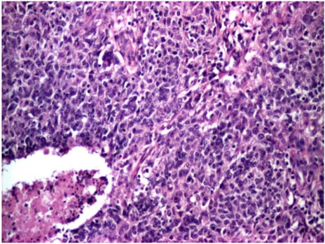 Figure 7- Marginal zone B-cell lymphoma, clinical aspect. A left- left-sided,  relatively  well-demarcated  preauricular,  firm,  non-tender  mass are observed