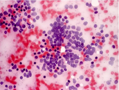 Figure 8- Marginal zone B-cell lymphoma, cytology. Smears are composed of two distinct lymphoid cell populations, both having indistinct  cellular margins