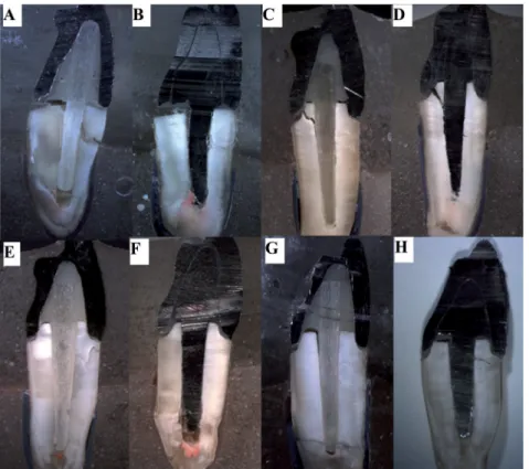 Figure 5-  Representative fractures evaluated under stereomicroscope 7.5x. Roots A and B restored with fiber post and cast post and  core, respectively without remaining coronal structure with displacement of the crown/core/post assembly and buccal fractur