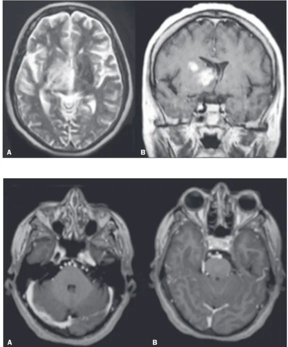 Figure 5. Female patient diagnosed  with Behçet’s disease.  Contrast-en-hanced T2-weighted and T1-weighted  MRI scans of the skull showing a  sub-capsular lesion with an expansile  ef-fect in the right thalamus, extending  to the subthalamus and right cere