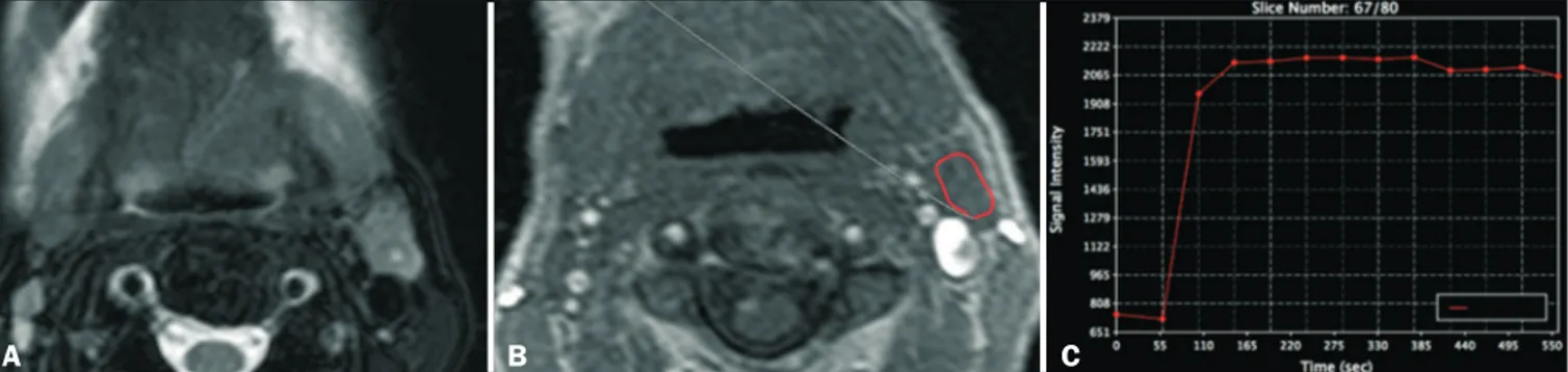 Figure 1. DCE MRI scan of a 72-year-old male patient with left oral tongue squamous cell carcinoma