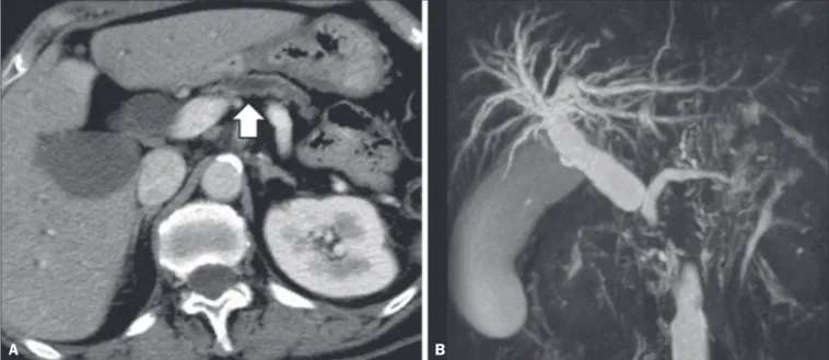 Figura 4. TC com contraste (A) e colangiorressonância (B). Neoplasia de cabeça de pâncreas causando dilatação do ducto pancreático principal (seta em A), com  atrofia do corpo e cauda do pâncreas e dilatação das vias biliares.