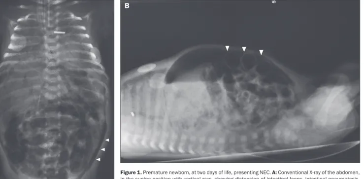 Figure 1.  Premature newborn, at two days of life, presenting NEC.  A:  Conventional X-ray of the abdomen,  in the supine position with vertical rays, showing distension of intestinal loops, intestinal pneumatosis,  air in the portal system, and pneumoperi
