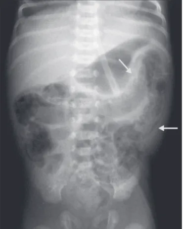 Figure 2.  X-ray of a preterm newborn, in the supine position with vertical rays,  indicating generalized distension of intestinal loops and pneumatosis (arrows)  in segments of the large and small bowel.