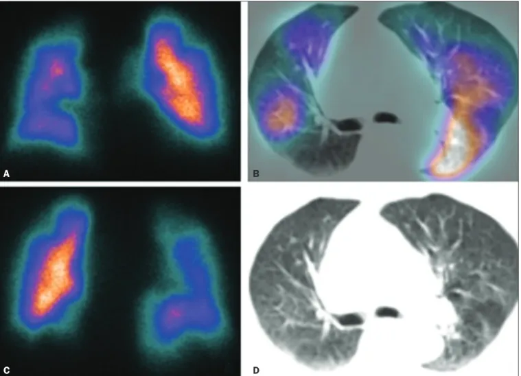 Figure 2. Pulmonary perfusion scintigraphy in coronal sections (A,B) and SPECT/CT in axial sections (C,D) in a 77-year-old male patient, demonstrating multiple  wedge-shaped perfusion defects bilaterally, without parenchymal alterations, indicating a high 