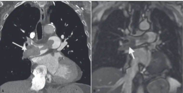 Figure 3. Correlation between a coronal CT slice (A) and a T2-weighted fast-spin-echo coronal MRI sequence (B ) showing a filling defect at the pulmonary artery  bifurcation.