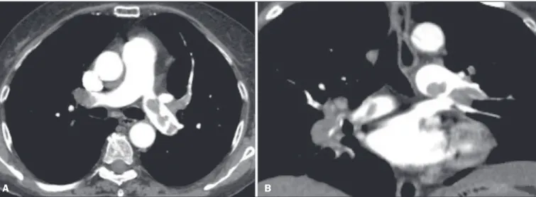 Figure 4. Acute PTE in a 62-year-old female patient. CT slices, in axial and coronal views (A and B , respectively), showing an extensive irregular filling defect in the  right and left pulmonary arteries, extending to its segmental branches.