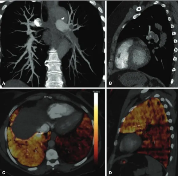 Figure 6. CT slices, in coronal and  sagittal views (A and B,  respec-tively),  showing  extensive  filling  defects affecting the pulmonary  artery branches, mainly in the  left lower lobe