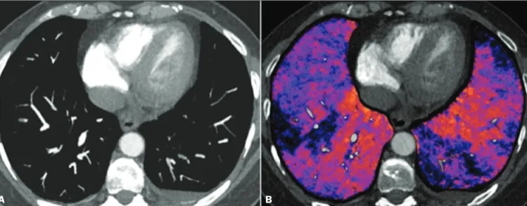 Figure 7. Axial CT slice (A) and iodine map created by the subtraction technique (B) showing bilateral filling defects in the subsegmental branches in correlation  with the associated perfusion defects.