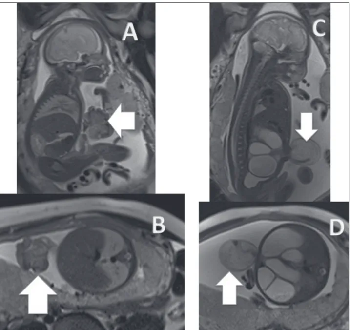 Figure 2. Gastroschisis. A,B:  Sagittal T2-weighted sequence of a fetus at 27 weeks, showing an abdominal wall closure defect and intestinal herniation (arrows)