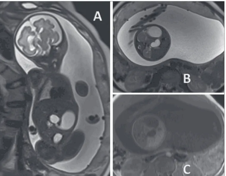 Figure 2. Duodenal atresia in a fetus at 32 weeks of gestation. A: Coronal T2-weighted sequence showing a dilated stomach, pylorus, and duodenal dilation