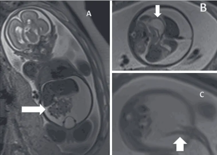 Figure 3. Idiopathic ascites in a fetus at 28 weeks of gestation. A:  Distended abdomen with a fluid collection showing a hyperintense signal in a coronal T2- T2-weighted sequence