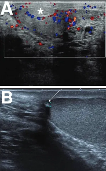 Figura 6. A: Torção do apêndice testicular aguda. Notar o aumento no tamanho  do apêndice testicular (asterisco), que não apresenta fluxo ao estudo Doppler