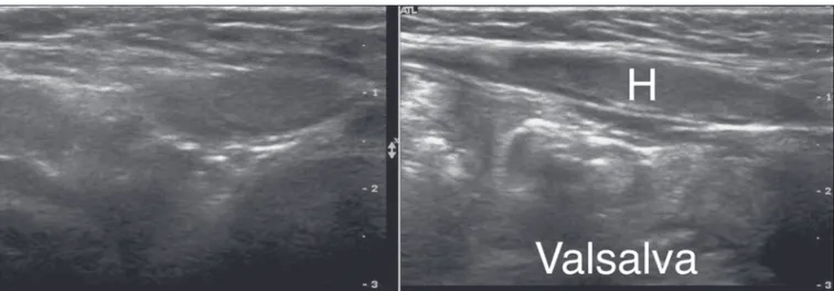 Figure 4. Direct inguinal hernia. Increased hernia content (H) after a Valsalva maneuver.