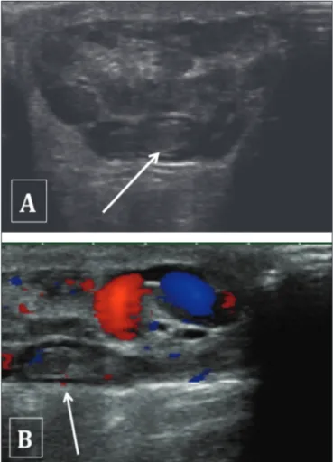 Figure 7. Heterogeneous testis and epididymis, both showing enlargement and  hypervascularity on the Doppler flow study