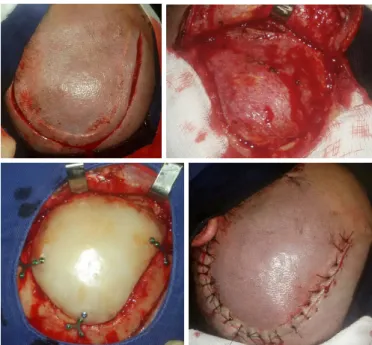 Figure 4. Postoperative aspect 15 days after removal of the stitches, with return of the                    aesthetics and function.
