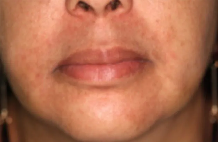 Figure 11. Patient at rest, with a slight alteration of the labial shape by lowering      the angle of the buccal commissure, right side, after undergoing the                     bichectomy surgery.
