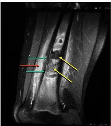Figure 2. Magnetic Resonance Imaging: hypointense area on the T1-weighted image  of the femur with fat suppression after contrast, revealed expansive mass  (yellow arrows), involving cortical (green arrows) and the presence of  exten-sive periosteal reacti