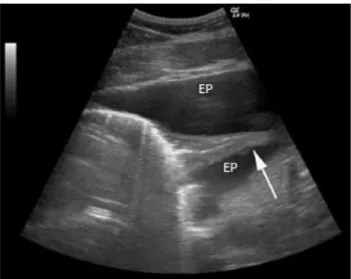 Figura 19: Ultrassonografia torácica de um cavalo com pleuropneumonia. Observa-se a presença de  efusão  pleural  (EP)  a  envolver  um  pulmão  com  atelectasia  (colapsado)  (seta)