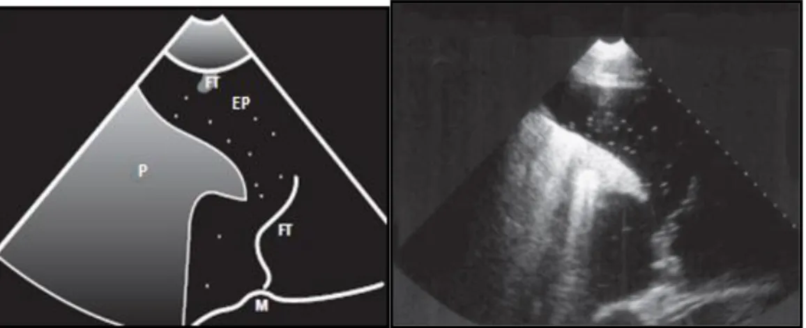Figura  24:  Ultrassonografia  torácica  de  um  cavalo  com  efusão  pleural  (F),  material  fibrinoso  (FT)  a  flutuar e atelectasia parcial do pulmão (P)