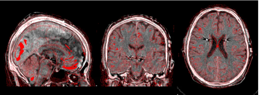 Figure 3.3: Normalization of post-operative CT to the MNI2009b space, previously registered to pre- pre-operative MRIs.