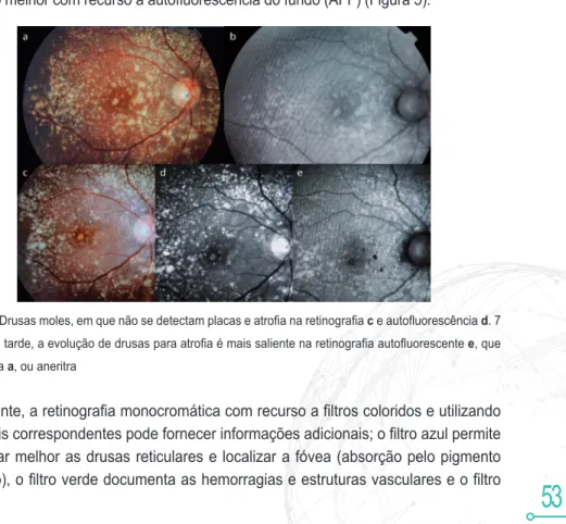 Figura 5: Drusas moles, em que não se detectam placas e atrofia na retinografia c e autofluorescência d