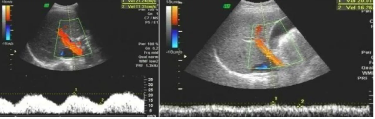 Figura  5  –   À  direita,  o  Doppler  portal  mostrando  nítida  pulsatilidade  da  veia  porta  (índice  venoso  portal  de  0,47)  e  à  esquerda baixa pulsatilidade (índice venoso portal de 0,18)