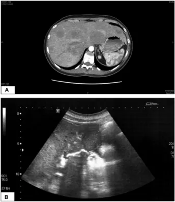 Fig. 3 (A) Computed tomography scan with hypoattenuating lesions in the hepatic parenchyma (arrows)
