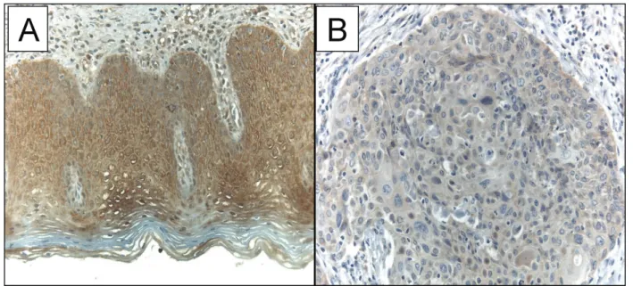 Fig. 1 WWOX cytoplasmic immunostaining. Normal cervical epithelium (A) and invasive squamous cell carcinoma (ISCC) (B)