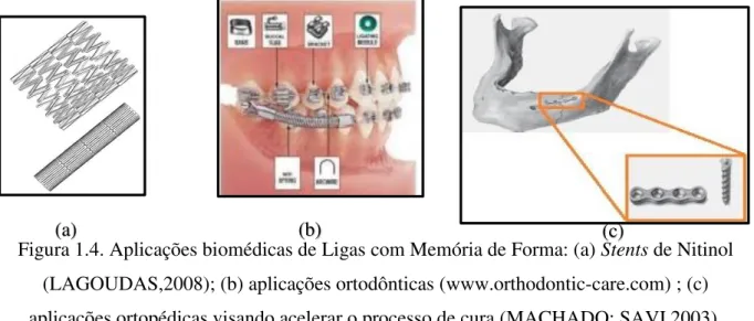 Figura 1.4. Aplicações biomédicas de Ligas com Memória de Forma: (a) Stents de Nitinol  (LAGOUDAS,2008); (b) aplicações ortodônticas (www.orthodontic-care.com) ; (c)  aplicações ortopédicas visando acelerar o processo de cura (MACHADO; SAVI,2003)