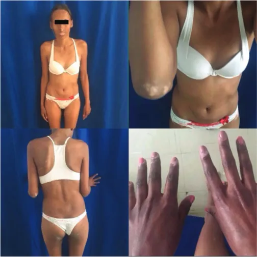 Fig. 1 Diffuse skin hyperpigmentation, vitiligoid stains (face, back, buttocks, and limbs) and nutritional status of the patient upon admission.