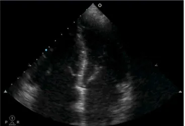 Figura 6 - Dilatação do ventrículo direito com retilinização sistodiastólica do  septo interventricular em contexto de tromboembolismo pulmonar agudo.