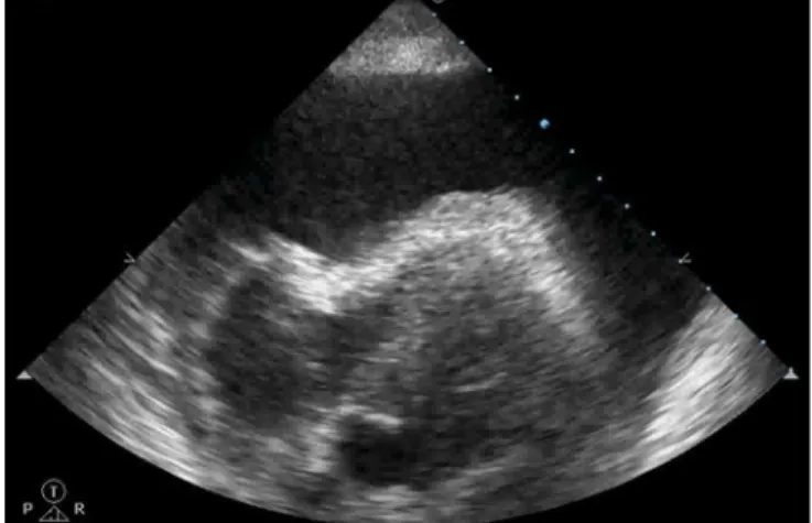Figure 4 - Cardiac tamponade.