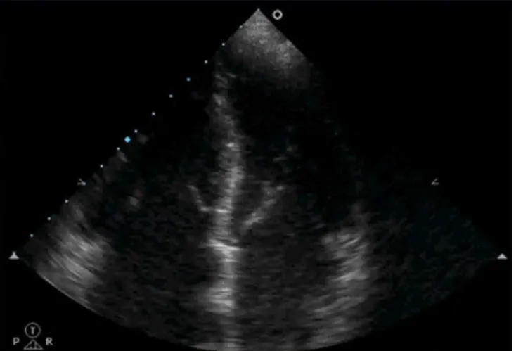 Figure 6 - Right ventricular dilation with bulging of the interventricular septum  towards the left ventricle under acute pulmonary thromboembolism.