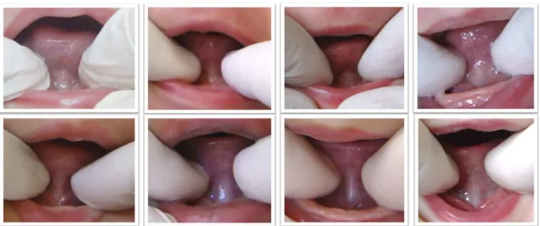 Figure 2.  Posterior frenulum not visualized by elevating the lateral margins of the tongue (simple maneuver)