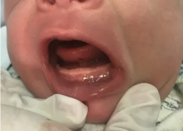 Figure 3. Newborn  placed  in  the  breast  immediately  after  the  surgical procedure
