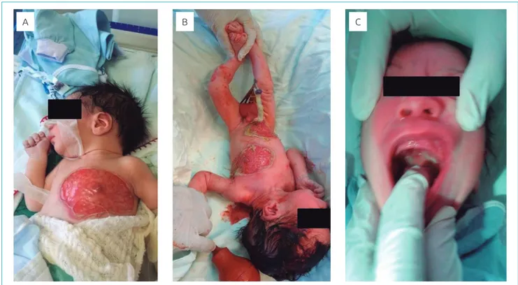 Figura 1 Lesões características do pênfigo vulgar neonatal ao nascimento. (A e B) imagens fotográficas mostrando  lesões vesicobolhosas extensas em região anterior do tórax e do abdome do neonato
