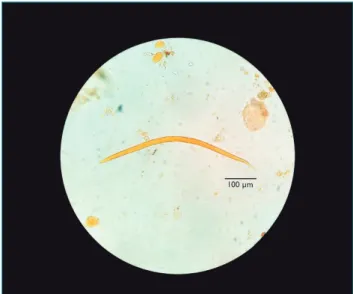 Figure 2 Filarioid larva of Strongyloides stercoralis  isolated from the second stool sample collected from  the father of the infant.