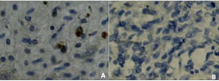 FIGURE 1: PHOTOMICROGRAPH OF THE HISTOLOGIC SECTION OF GLIOMAS, SHOWING SOME NUCLEI STAINED  BROWN FOR ESTROGEN RECEPTORS IN LOW-GRADE ASTROCYTOMAS (A) AND ABSENCE OF NUCLEI STAINED IN  HIGH-GRADE ASTROCYTOMAS (B).