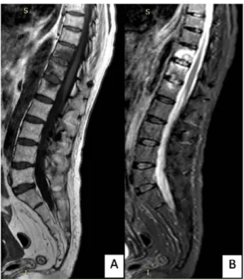 FIGURE 1 – Sagittal T2 sequence thoracic spine MRI show- show-ing vertebral body edema at T1112 and T12L1 in the  interver-tebral discs