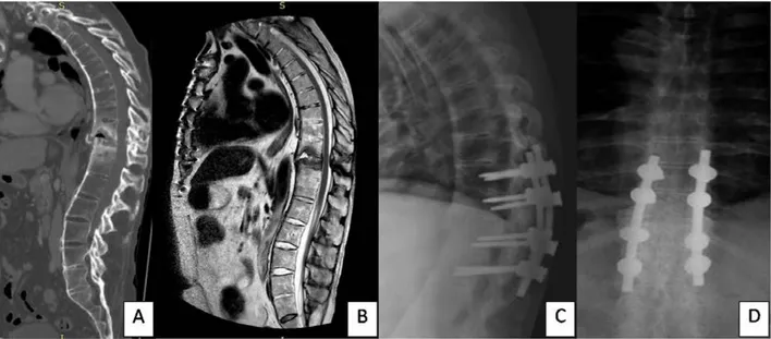 FIGURE 2 – This 54 patient had a fall from the height 2 months before, developing chronic low back pain